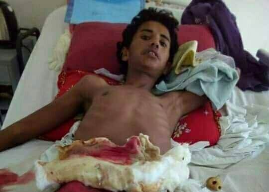 صورة للطفل محمد حسن سلامة أحد مصابين الاستهداف العشوائي لقوات الجيش والشرطة المصرية